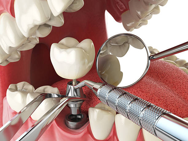 Best Emergency Tooth Extraction in Englewood, CO